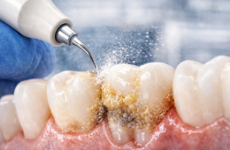 Kamień nazębny – czy jest groźny i jak się go usuwa?